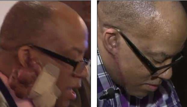 Foto via wbrcCrowell litt fast 13 Jahre lang und war nicht in der Lage, eine Versicherung zur Zahlung seiner Eingriffe abzuschließen, da er behauptete, sein Zustand sei eher ein kosmetisches Problem als ein gesundheitliches Problem. Crowell debattierte über diese Entscheidung und bestand darauf, dass sein Zustand sein Hören und Schlucken hemme. Er sagte: „Ich glaube, es ist nicht kosmetisch. Das ist mein Lebensunterhalt. Das ist mein Leben hier.“ Crowells Position als Casino-Sicherheitsbeamter bedeutet, dass er jeden Tag mit Menschen von Angesicht zu Angesicht interagieren muss.