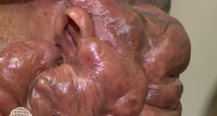 Foto via wbrcAn einem Punkt hatte Crowell fast 40 Pfund überschüssiges Fleisch, das von seinem Gesicht hing, aber er verlor nie die Hoffnung. Der in die Kirche gehende Mann nahm ein Mantra an: „Bete, bis etwas passiert.“ Und dann tat sich endlich eines Tages etwas!