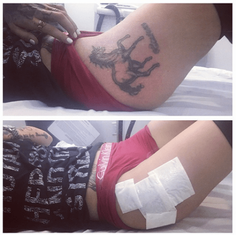 Ruby Rose teilt nach der ersten von 10 Tattooentfernungssitzungen ein Foto.