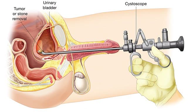 Foto über drtimnathan-urologyOkay, ich hatte dieses Verfahren dreimal und die ersten beiden kamen der Folter am nächsten, die ich je erlebt habe. Wieso den? Ich sage dir warum. Die ersten beiden Male hatte ich einen Arzt, der mir ein Wattestäbchen mit einem beschissenen Anästhetikum direkt in mein Schwanzloch schob. Eeeek! Es wird nur noch schlimmer. Dann nahm er ein starres Metallrohr und steckte es dort unten und in meine Blase, dann führte eine Art Draht mit einer Kamera dort unten… und das alles passierte in der Arztpraxis, während ich in mein Portemonnaie biss. Brutal! Das dritte Mal war viel humaner. Dieser Arzt benutzte einen dünnen, flexiblen, sehr dünnen Schlauch, der zwar SUPER unbequem war und das gesamte Konzept jeden Mann oder jede Frau dazu bringen wird, mitfühlend in den Schritt zu greifen, es war jedoch relativ schmerzlos. Holen Sie es also, wenn Ihr Arzt Ihnen dazu rät. Oh, ich habe vergessen, Ihnen zu sagen, was und warum bei der Prozedur. Hier geht's ... ein Zystoskop ist ein dünnes Rohr mit einer Kamera und Licht am Ende. Während einer Zystoskopie führt ein Arzt diesen Schlauch durch Ihre Harnröhre (den Schlauch, der Urin aus Ihrer Blase befördert) und in Ihre Blase ein, damit er das Innere Ihrer Blase sehen kann. Dies ist darauf zurückzuführen, die Blutquelle im Urin, Blasensteine, potenzielle Krebsrisiken und Probleme mit Ihren Nieren zu finden.