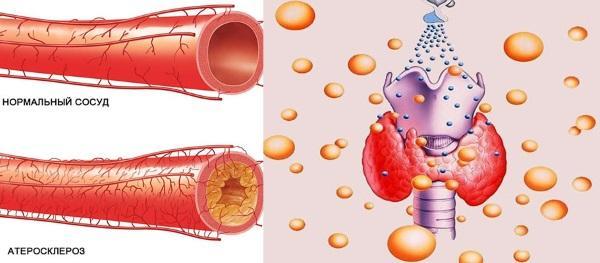 Artrosis e insuficiencia hormonal de la glándula tiroides.