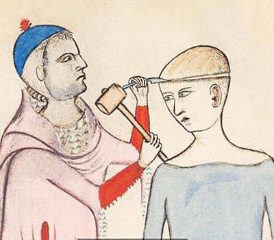 Foto via BBC Laut einem Artikel von BBC Earth geht die Trepanation ungefähr 7.000 Jahre zurück und wurde von den alten Griechen, Chinesen, Römern, Ägyptern und den Ureinwohnern Nord- und Südamerikas, des Fernen Ostens, Polynesiens und Afrikas durchgeführt. Das Verfahren war grausam und beinhaltete das Bohren eines Lochs in den Schädel einer lebenden Person durch Schneiden, Bohren oder Abkratzen von Haut- und Knochenschichten mit einem scharfen Gegenstand.