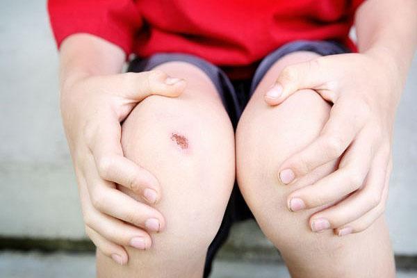 la teinture de calendula désinfecte les plaies