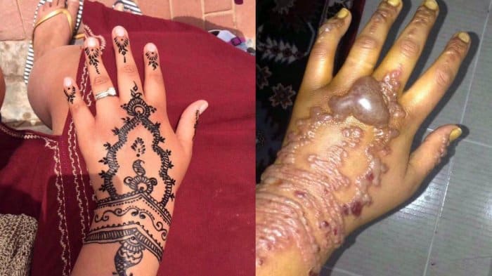 Foto via dailymailSophie, eine 22-jährige Engländerin war im Urlaub in Marokko, als sie beschloss, Henna auf ihre Hände zu bekommen. Sophie wartete tatsächlich 24 Stunden, um zu sehen, ob ihre Haut eine allergische Reaktion zeigen würde, was nicht der Fall war. Sie zahlte die 10 Dollar und ließ das Henna aufführen. Innerhalb von Stunden waren ihre Hände geschwollen und hatten Blasen.