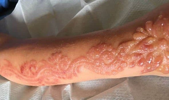 Foto via expressDie Primarschülerin Madison Gulliver war mit ihrer Familie im Urlaub in Ägypten, als ihr Vater zustimmte, Madison von einem Verkäufer in dem Vier-Sterne-Hotel, in dem sie wohnten, ein temporäres Tattoo stechen zu lassen. Das Blumenmuster erstreckte sich von ihren Fingern an ihr rechte Hand, den ganzen Weg über den Arm bis zum Ellbogen. Leider fing sie nur Stunden später an, sich darüber zu beschweren, dass das Tattoo juckte und schnell in schmerzhafte, leuchtend rote Blasen ausbrach. Das arme Mädchen wurde vor Schmerzen schreiend ins Krankenhaus eingeliefert und hat möglicherweise Angst ums Leben.