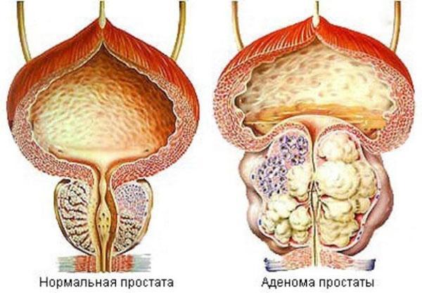 veselka aux champignons pour le traitement de la prostate
