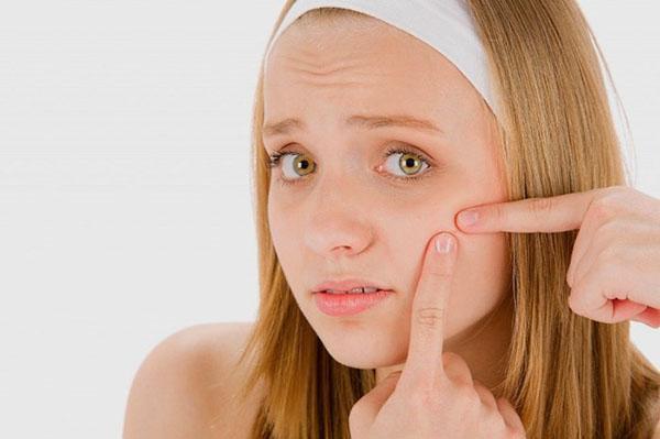 luchar contra el acné