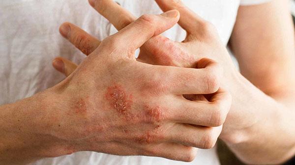 huile d'onagre pour le psoriasis