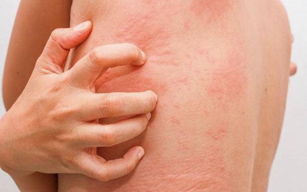 réaction allergique