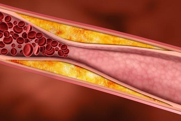 élimine les plaques de cholestérol