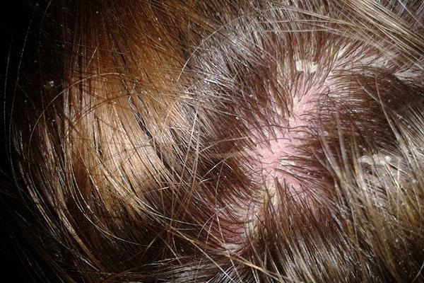réaction allergique à l'écorce de chêne