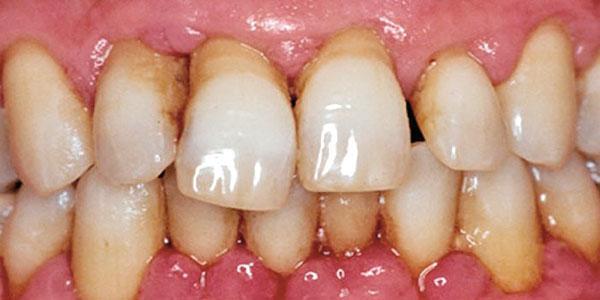 enfermedad periodontal