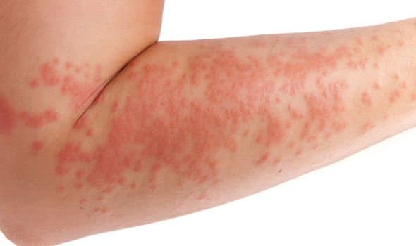 Wenn Sie an einer bereits bestehenden Hauterkrankung (Ekzeme, Rosacea und Psoriasis usw.) um Juckreiz und weitere Komplikationen Ihres Immunsystems zu verhindern. Wir möchten es hier wiederholen. Wenn Sie glauben, dass Ihr Tattoo infiziert ist, suchen Sie bitte so schnell wie möglich einen Arzt auf. Eine Infektion kann dazu führen, dass Ihr Tattoo ruiniert wird und zu einem ernsthaften Gesundheitsproblem führt.