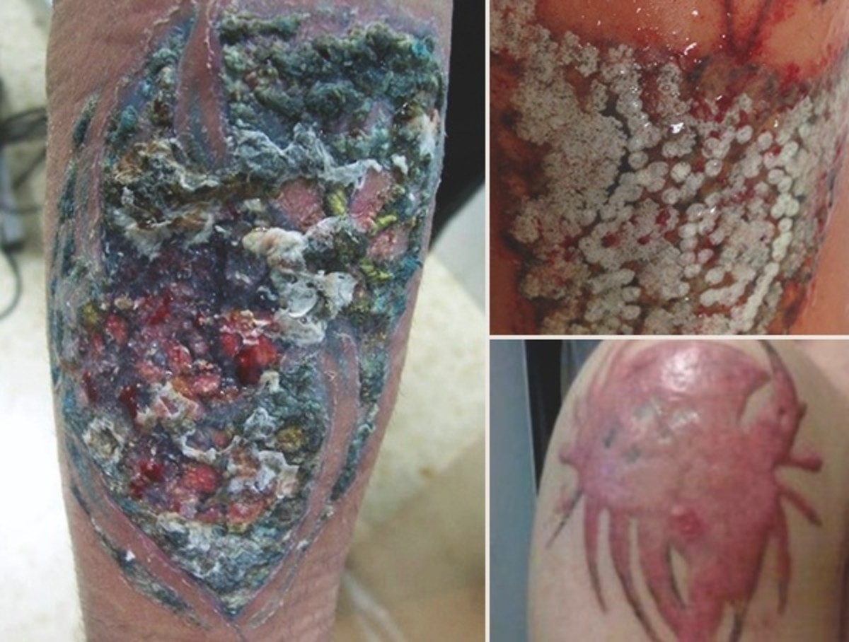 kožní příznaky-infikovaných-tetování