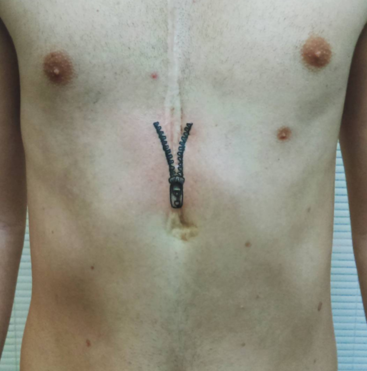 otevřené tetování jizvy po operaci srdce