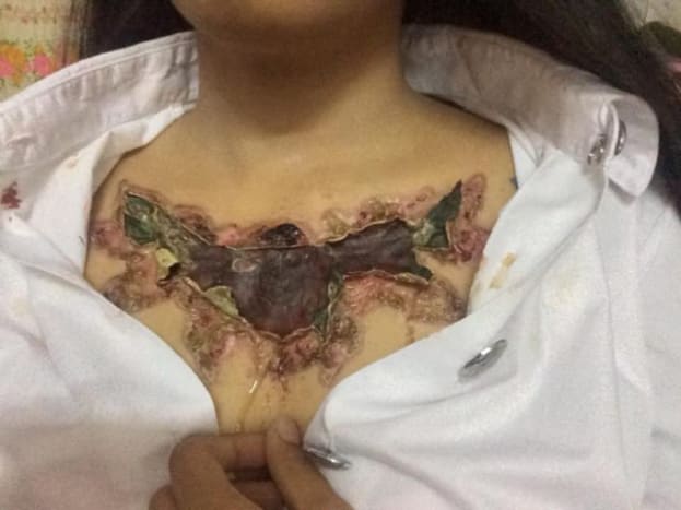 Fotografie přes instagram Zdá se, že tetovaná kůže je nekrotizovaná.