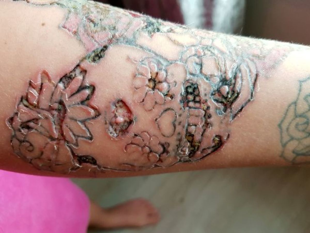 Stephanie Lynn, fleischfressende Käfer, Tattooentfernung schief gelaufen, Hochzeit verschieben, frisches Gesicht, Laserentfernung, Tattooentfernung