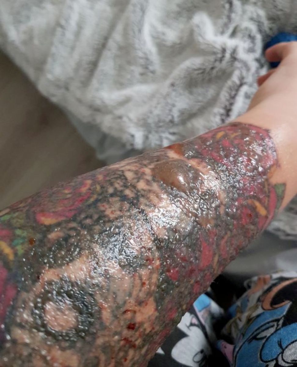 Stephanie Lynn, fleischfressende Käfer, Tattooentfernung schief gelaufen, Hochzeit verschieben, frisches Gesicht, Laserentfernung, Tattooentfernung