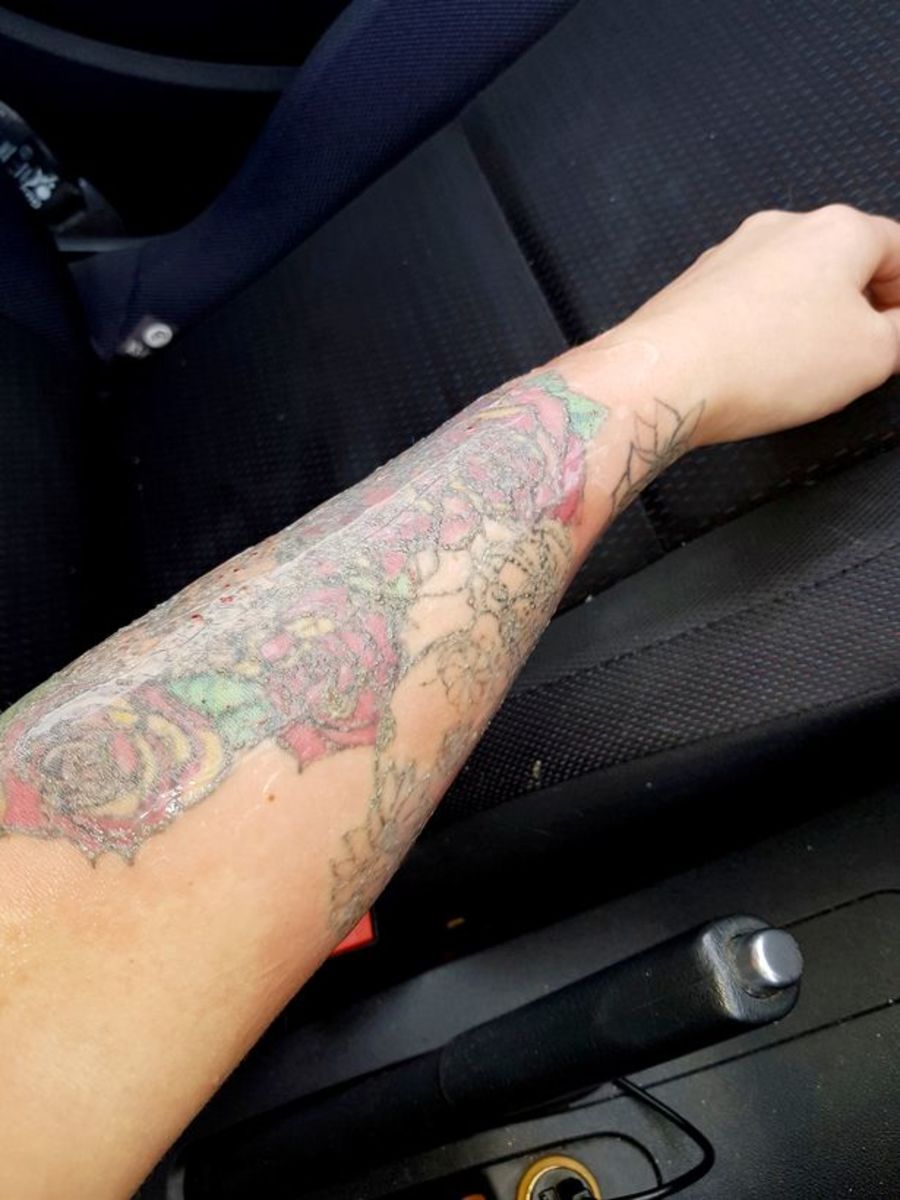 Stephanie Lynn, fleischfressende Käfer, Tattooentfernung schief gelaufen, Hochzeit verschieben, frisches Gesicht, Laserentfernung, Tattooentfernung