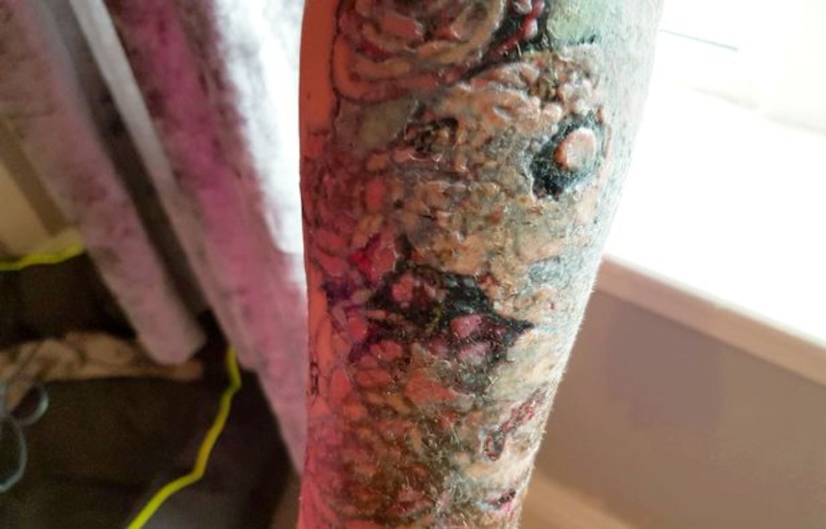 Stephanie lynn, maso jí chyby, odstranění tetování se pokazilo, odložit svatbu, nový obličej, odstranění laserem, odstranění tetování