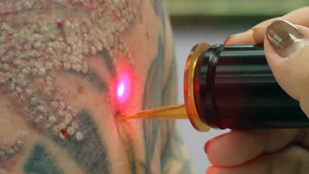 Výzkumná studie vydaná Market Research Future předpovídá, že do roku 2022 má trh s odstraněním tetování dosáhnout 3,5 miliardy dolarů! Přestože studie zahrnuje chirurgii, krémy a jiné formy odstranění, laser je nejvíce doporučovanou formou a zaujímá dominantní místo v metodách odstraňování tetování. Odstranění laserem drželo největší podíl na trhu od roku 2015 a očekává se, že bude i nadále vedoucím trhem do roku 2022. Podle Market Watch tržby za odstranění tetování za poslední desetiletí vzrostly o 440% na odhadovaných 75,5 milionu dolarů, přičemž výdaje na odstranění tetování by měly příští rok dosáhnout 83,2 milionu dolarů. Díky klinikám pro odstranění tetování laserem, jako je Tatt-Away v Tampě na Floridě, odstraníte více než 300 tetování měsíčně za téměř 500 dolarů za pop, takže toto číslo není překvapením.