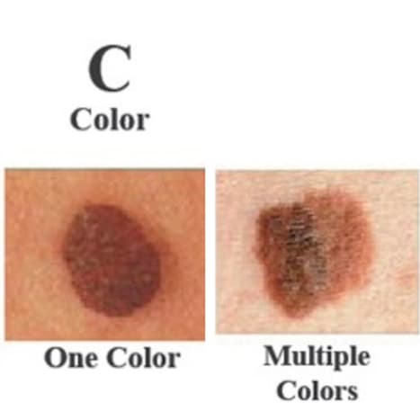 Foto über skincancer.orgDie meisten gutartigen Muttermale haben alle eine Farbe – oft ein einziger Braunton. Eine Vielzahl von Farben ist ein weiteres Warnsignal. Es können verschiedene Braun-, Braun- oder Schwarztöne auftreten. Ein Melanom kann auch rot, weiß oder blau werden.