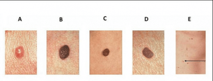 Foto via skincancer.org Um es einfach auszudrücken, verwenden Dermatologen die sogenannte ABCDE-Regel – Asymmetrie, unregelmäßiger Rand, Farbe, Durchmesser und Entwicklung.