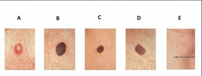 Foto přes skincancer.org Jednoduše řečeno, dermatolog používá to, co je známé jako pravidlo ABCDE - asymetrie, nepravidelné ohraničení, barva, průměr a vývoj.