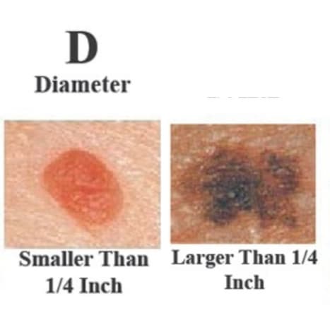 Foto via skincancer.orgGutartige Muttermale haben normalerweise einen kleineren Durchmesser als bösartige. Melanome haben normalerweise einen größeren Durchmesser als der Radiergummi an Ihrer Bleistiftspitze (¼ Zoll oder 6 mm), aber sie können manchmal kleiner sein, wenn sie zum ersten Mal entdeckt werden.