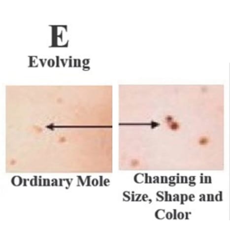 Foto über skincancer.orgHäufige, gutartige Muttermale sehen im Laufe der Zeit gleich aus. Seien Sie wachsam, wenn sich ein Maulwurf entwickelt oder sich in irgendeiner Weise verändert. Wenn sich ein Muttermal entwickelt, gehen Sie zum Arzt. Jede Veränderung – in Größe, Form, Farbe, Höhe oder einem anderen Merkmal oder jedes neue Symptom wie Blutung, Juckreiz oder Krustenbildung – weist auf eine Gefahr hin.