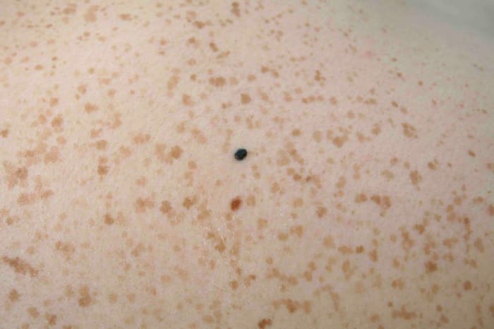 Foto přes skincancer909 Nenechte se tetovat přímo nad krtky nebo pihami. Pokud jste již na některém z těchto míst vytetováni, můžete tyto oblasti stále sledovat pomocí pravidla ABCDE - bez „C“.