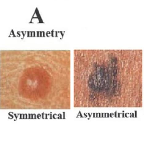 Foto über skincancer.orgDieser gutartige Muttermal ist nicht asymmetrisch. Wenn Sie eine Linie durch die Mitte ziehen, passen die beiden Seiten zusammen, was bedeutet, dass es symmetrisch ist. Wenn Sie eine Linie durch diesen Maulwurf ziehen, passen die beiden Hälften nicht zusammen, was bedeutet, dass er asymmetrisch ist, ein Warnzeichen für ein Melanom.