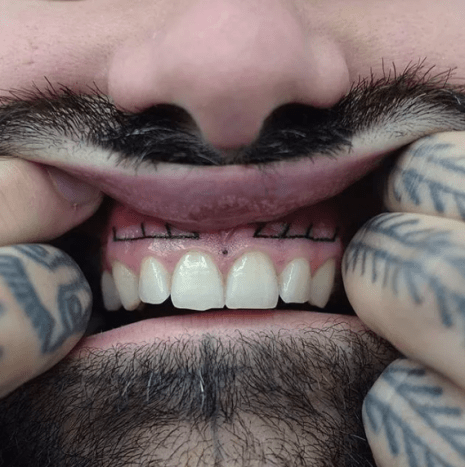 Als jemand, der beobachtet hat, wie sich eine andere Person das Zahnfleisch tätowieren lässt, tut dieses Tattoo mehr weh, als man denkt. Innenlippe, ein Stück Kuchen. Aber direkt über den Zähnen tätowiert zu werden, ist eine ganz andere Erfahrung.