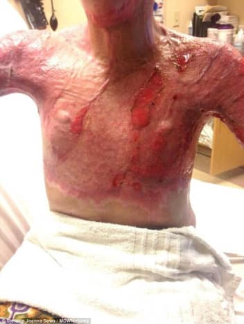 Als Sowa im Krankenhaus aufwachte, hatte sie Verbrennungen an 40% ihres Körpers und musste sich über 50 Korrekturoperationen unterziehen – darunter mehrere Hauttransplantationen, Hautexpander und mehrere Sitzungen mit Laserbehandlungen.